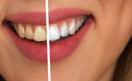 Comment avoir des dents blanches avec une dentition fragile ?